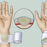 施加压力的绷带