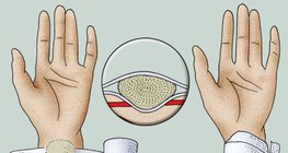 施加压力的绷带