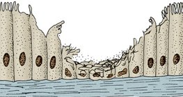 吸烟者呼吸道的纤毛上皮